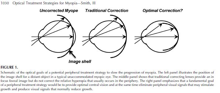 &nbsp;[[ Peripheral Myopia Correction ]]&nbsp;